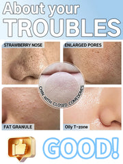 Blackhead Remover Vacuum Pore Deep Cleansing Device