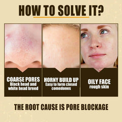 Pore Shrink Oil Control Anti-Acne Facial Serum